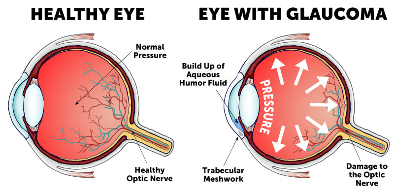 Vergleich von einem gesunden Auge und einem Auge mit Glaukom, der den Druckaufbau und die Schädigung des Sehnervs im Glaukom-Auge zeigt.